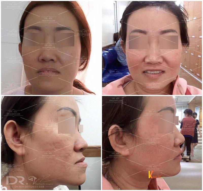 Hình ảnh thay đổi sau phẫu thuật chỉnh hình hàm móm