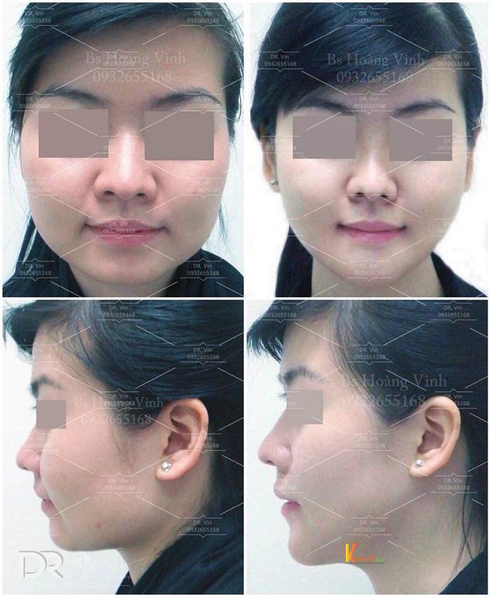 Thay đổi sau khi hạ gò má và gọt góc hàm, độn cằm và trượt cằm