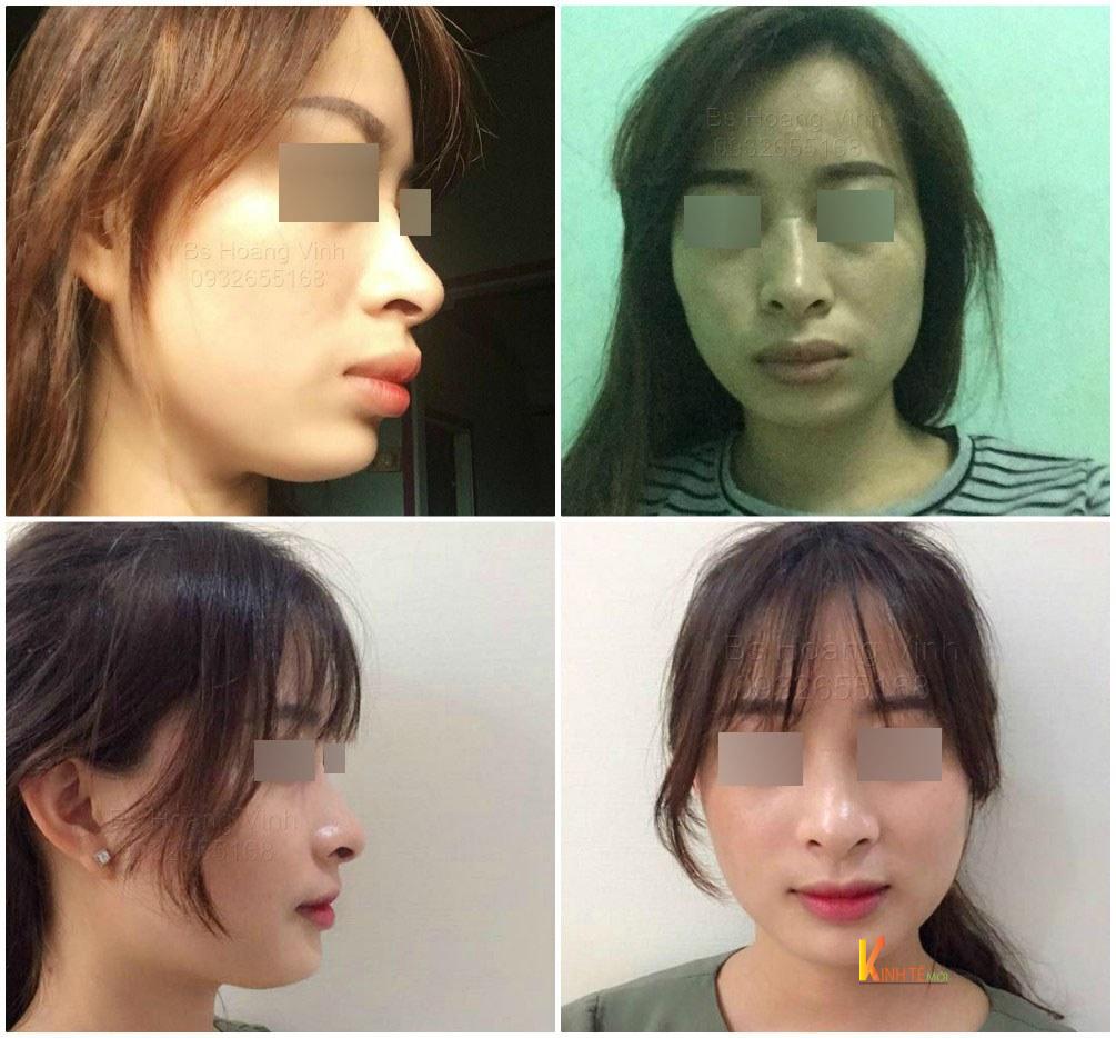 Hình ảnh thay đổi sau phẫu thuật chỉnh hô 2 hàm