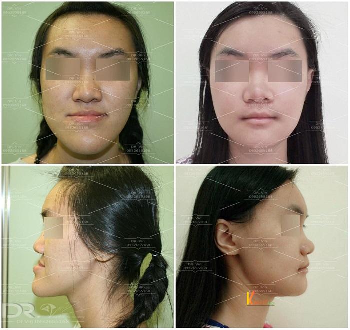 Hình ảnh thay đổi sau phẫu thuật chỉnh hình hàm móm