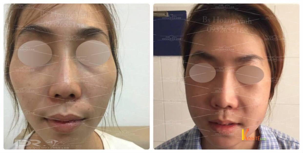 Hình ảnh thay đổi sau khi hạ gò má