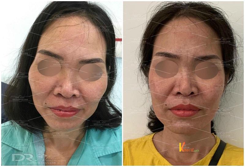 Hình ảnh thay đổi sau khi hạ gò má