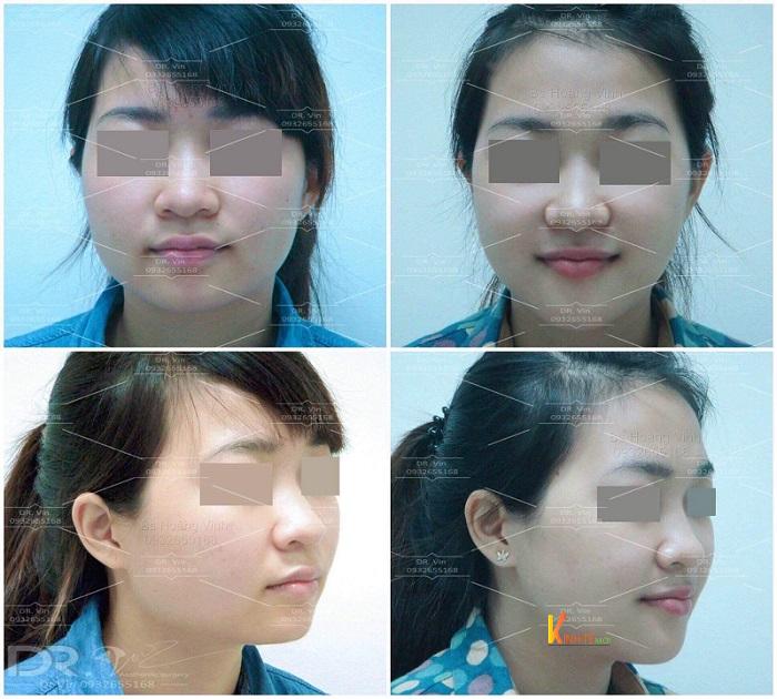 Thay đổi sau khi hạ gò má và gọt góc hàm, độn cằm và trượt cằm